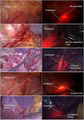 Ideal Anatomical Landmark Points for Thoracic Esophagus Segmentation in the Chinese Population